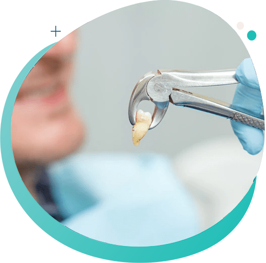 wisdom teeth removal calgary