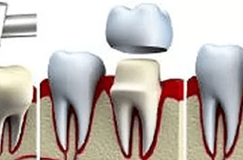 procedure dental