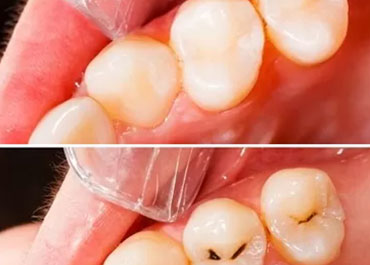 front tooth cavity filling