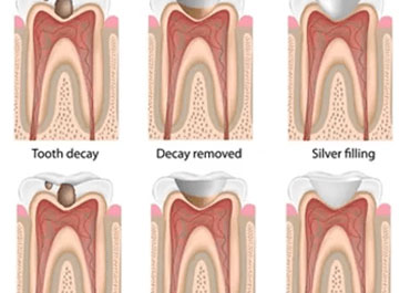 dental filling calgary
