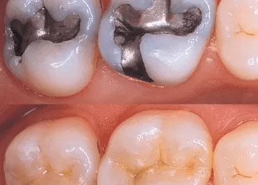 front tooth filling