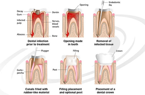 canal treatment done