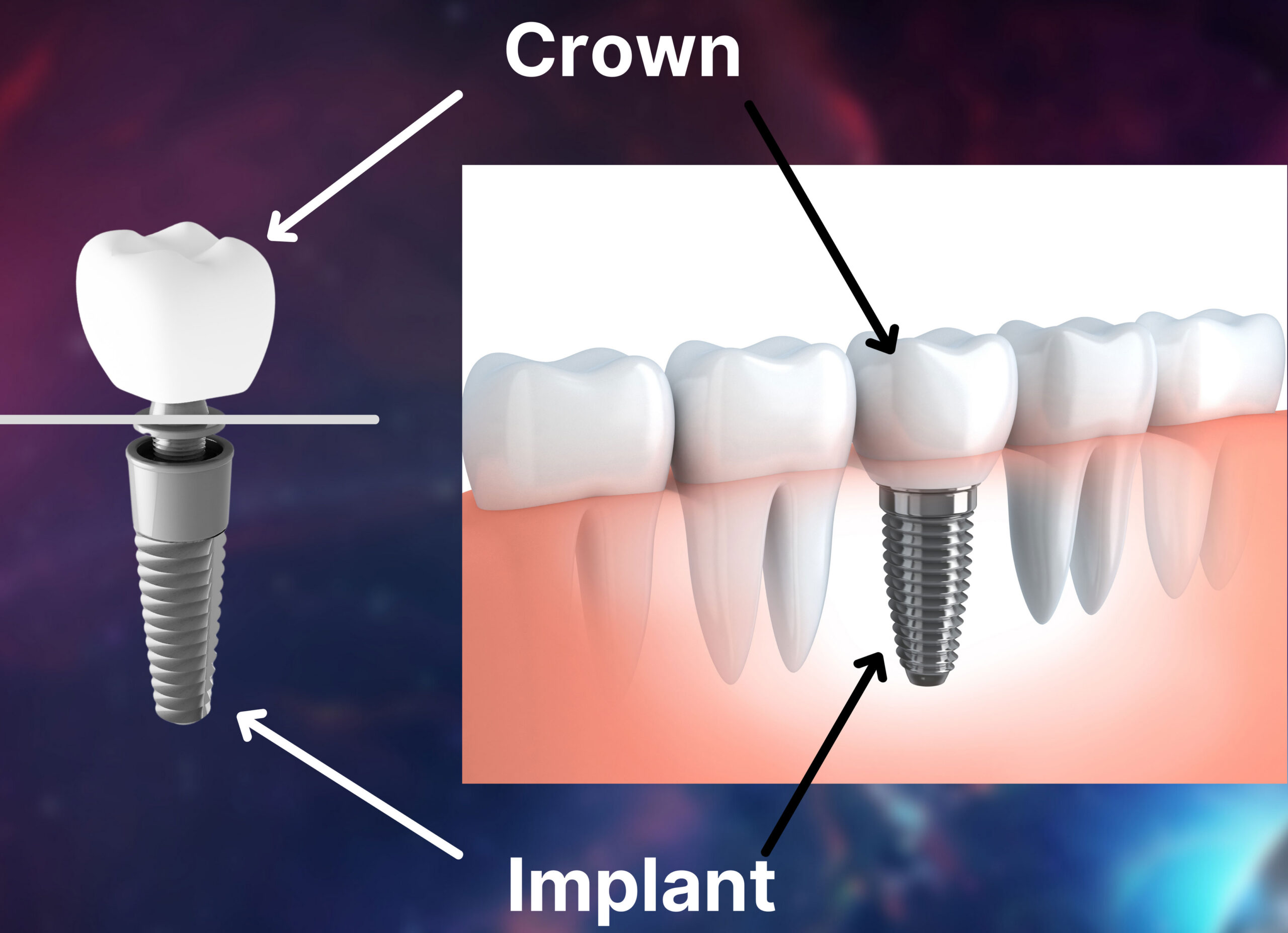crown implant